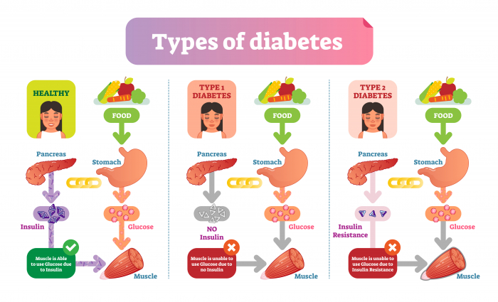 Image of types of diabetes